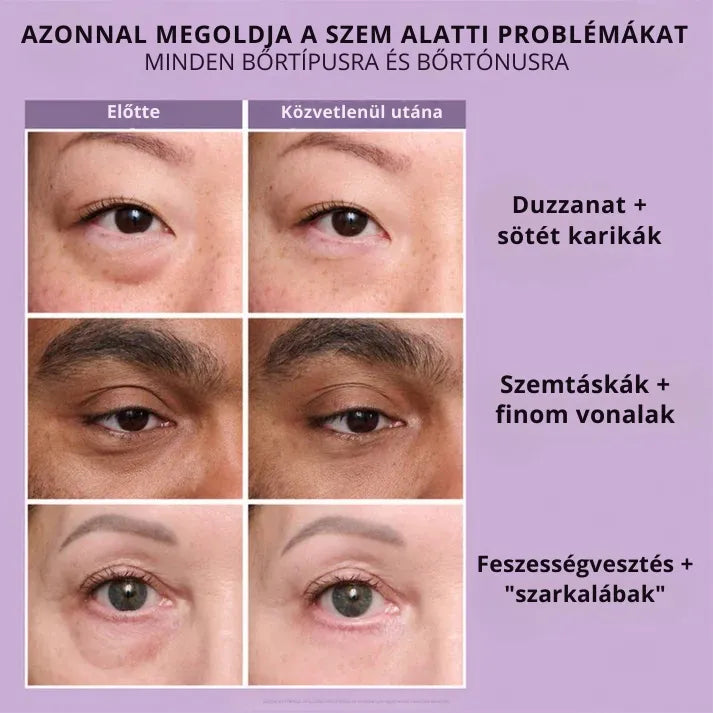 Daynava™ Azonnali Szemkörnyék-Lifting